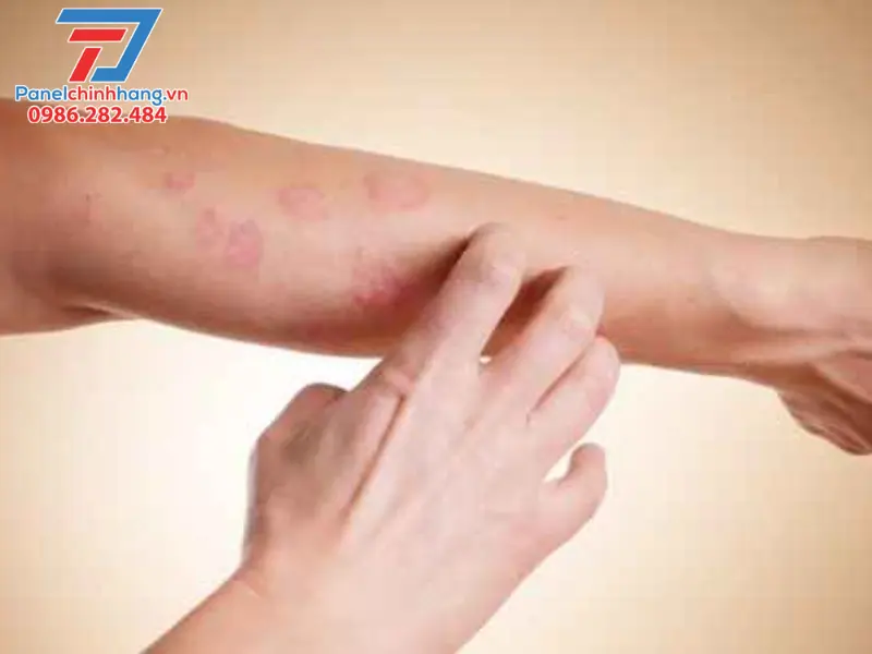 Cách trị ngứa bông thủy tinh tại nhà